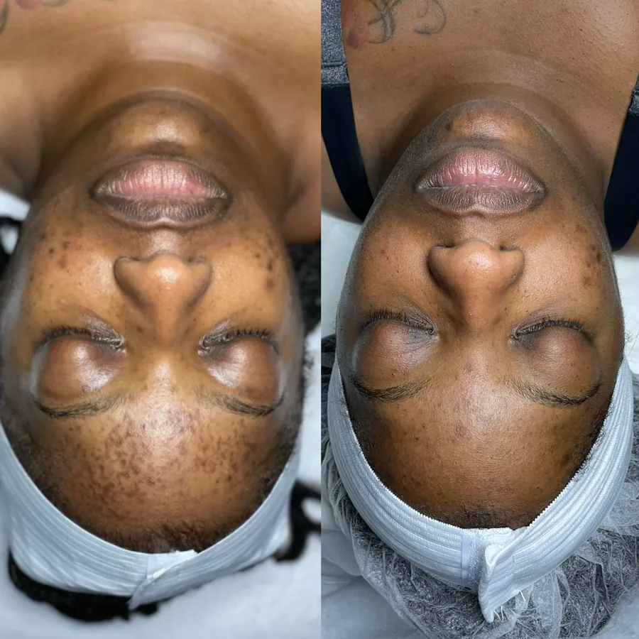 Skin transformation result