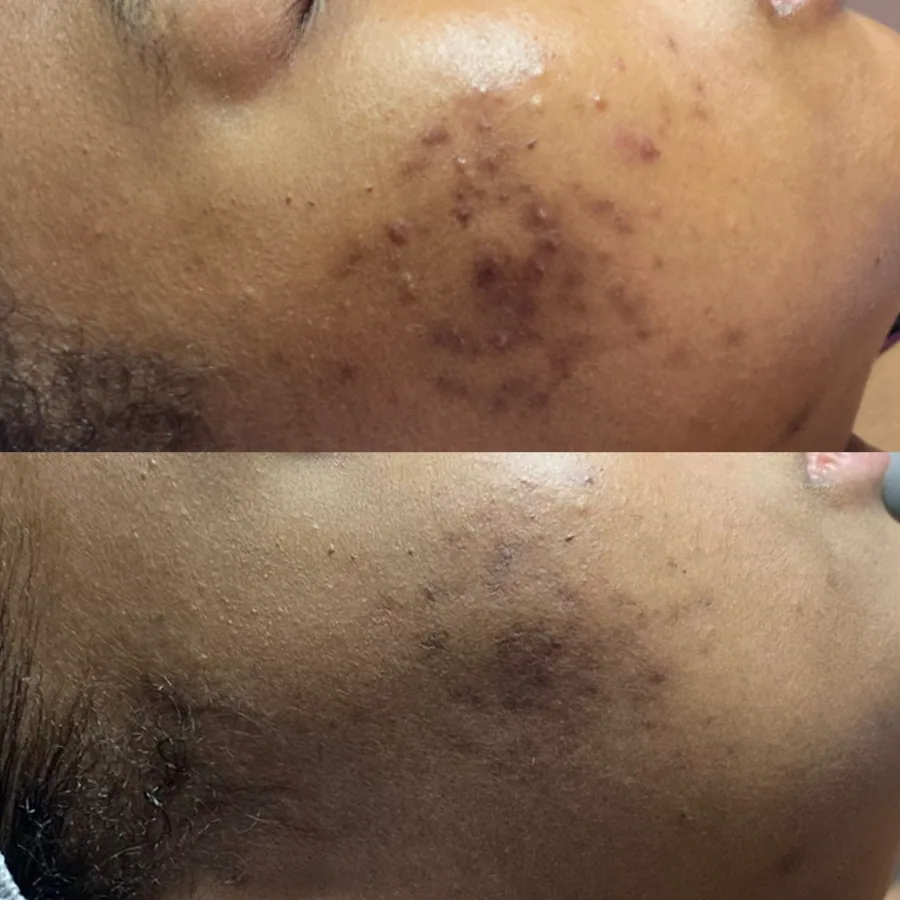 Skin transformation result