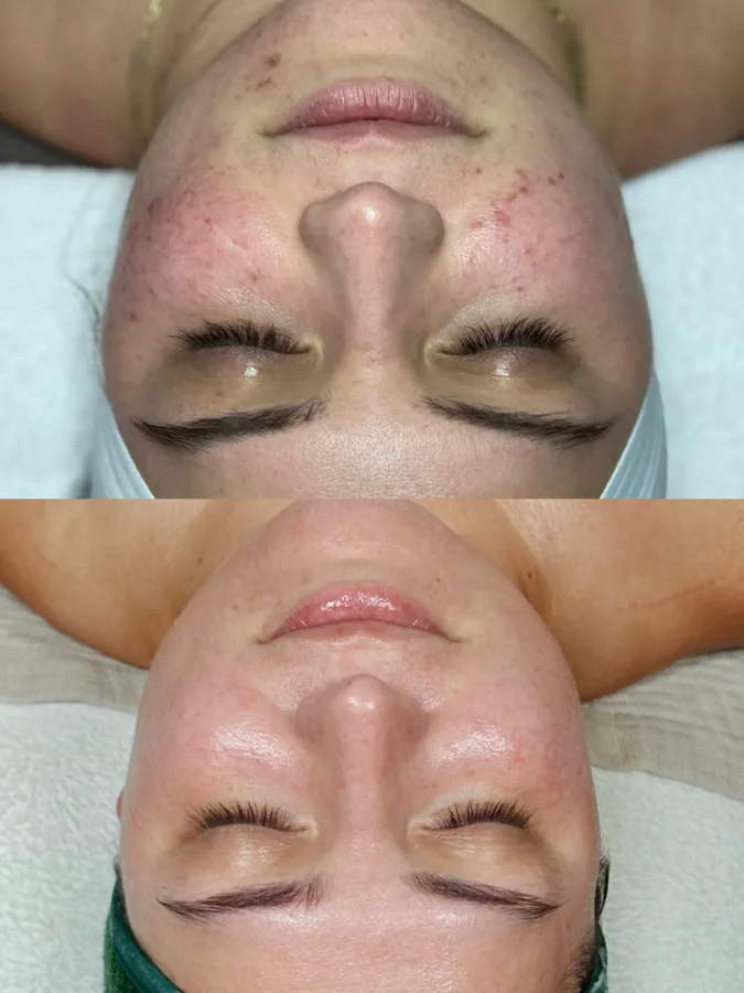 Skin transformation result