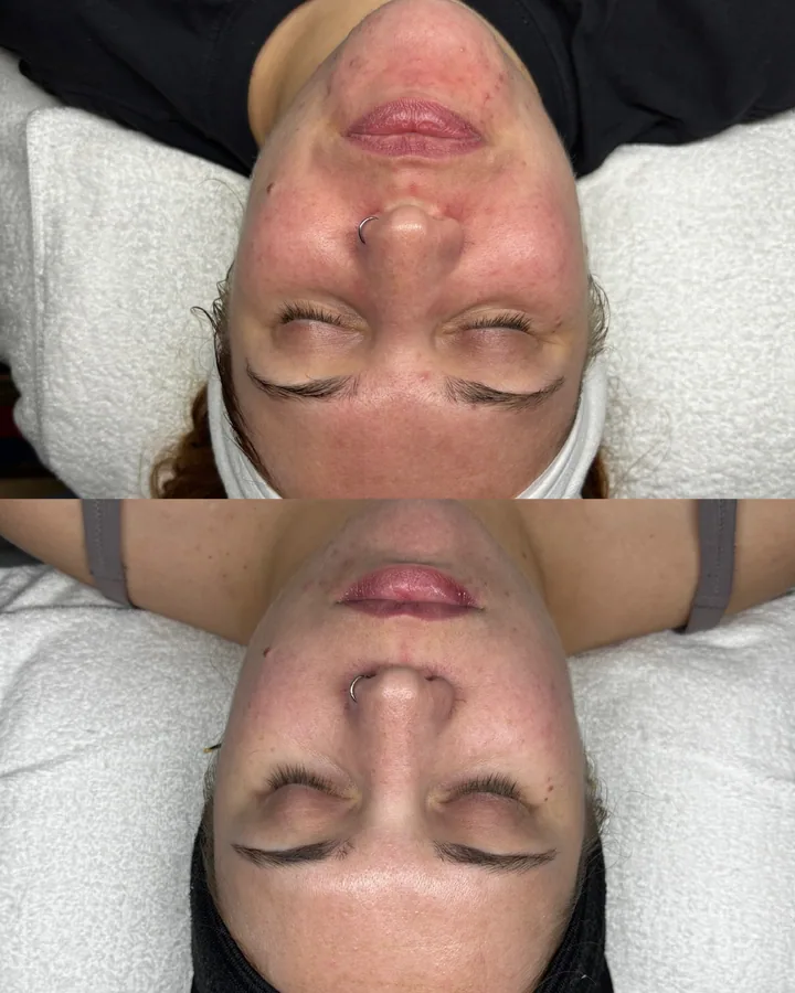 Skin transformation result