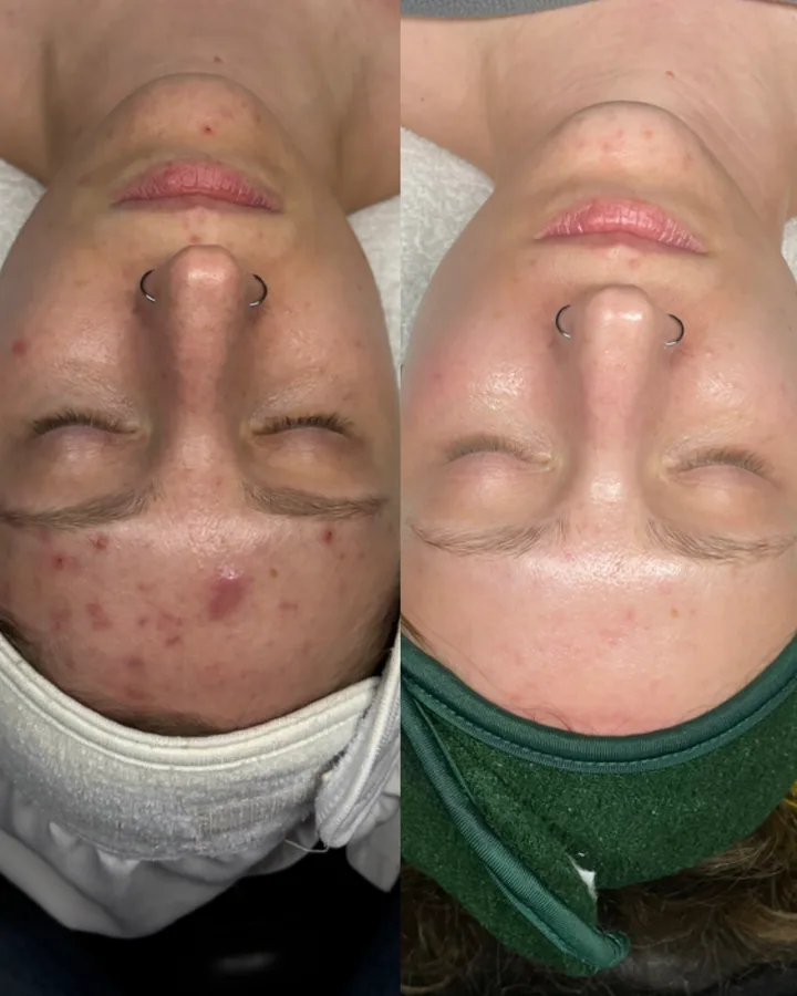 Skin transformation result