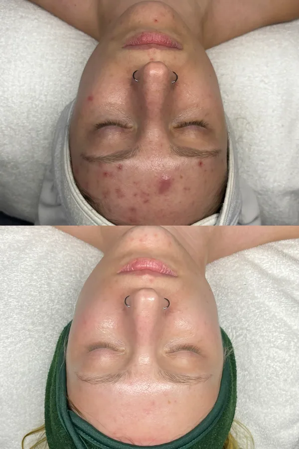 Skin transformation result